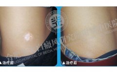  白癜风治疗期间如何巩固疗效  