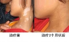 患白癜风需要汲取哪些营养 