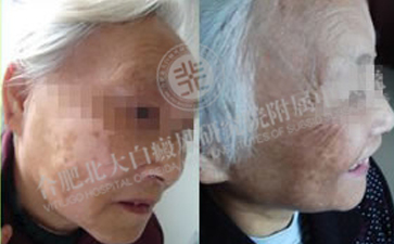  突发老年面部白斑怎么治疗  