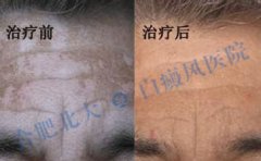 老人患了白癜风需要注意哪些问题呢 