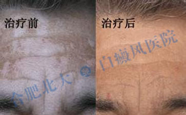 白癜风的治疗需要注意哪些禁忌 