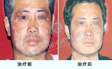  肢端患上白癜风该怎么样进行治疗呢  