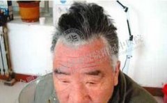 一般不严重的白癜风选择什方法就治 