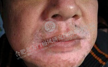 适量的运动对白癜风患者有好处吗 