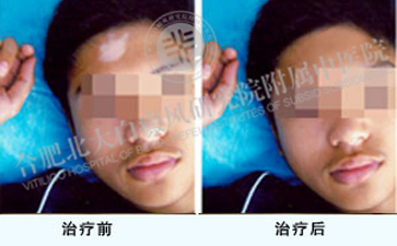 男性白癜风真的治不好吗 