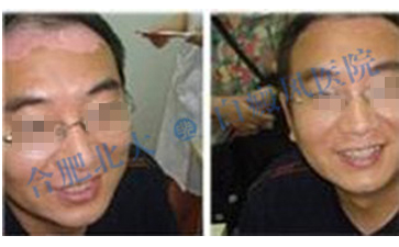  男性白癜风复发的原因是什么呢  