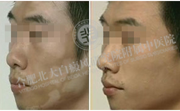 男性白癜风要如何预防呢 
