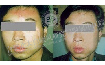 男性白癜风病因一般是什么 