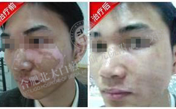 男性白癜风患者怎么保护自己的皮肤 