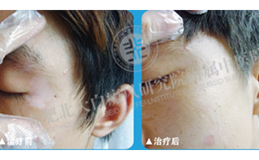  男性白癜风治疗的误区是什么  