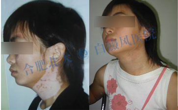 女性白斑患者饮食需注意什么 