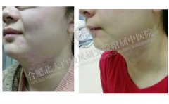 在怀孕期间得了白癜风会遗传给孩子 