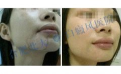 白癜风如果不及时治疗会有什么后果 
