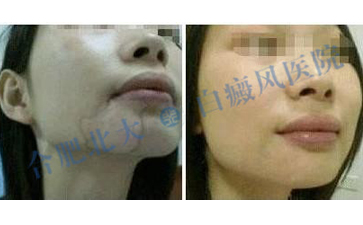 女性白斑要怎么治疗才好呢 
