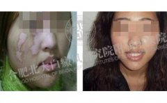 哺乳期得了白癜风会不会传染给孩子 