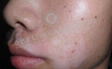  青少年不幸得了白癜风可以治好吗  