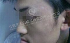 青少年白癜风家长要注意什么 