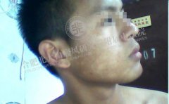  青少年白癜风患不要吃什么东西  