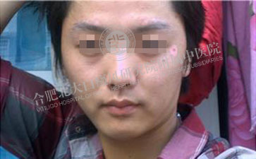 青少年白癜风治疗有什么原则呢 
