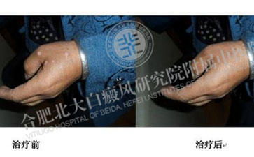  手部患上了白癜风要注意哪些问题  