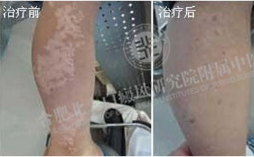 怎样判断自己腿上的白斑呢 