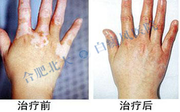 手部轻易患上白癜风究竟是为什么 