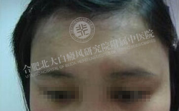  民间偏方治白斑可行吗  